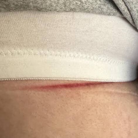 bra band fit too tight red marks